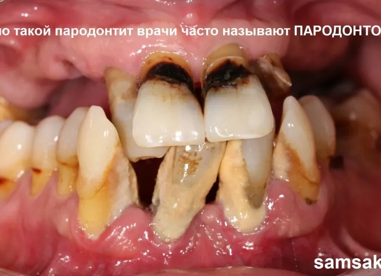 Можно ли вылечить воспаление десен самостоятельно?