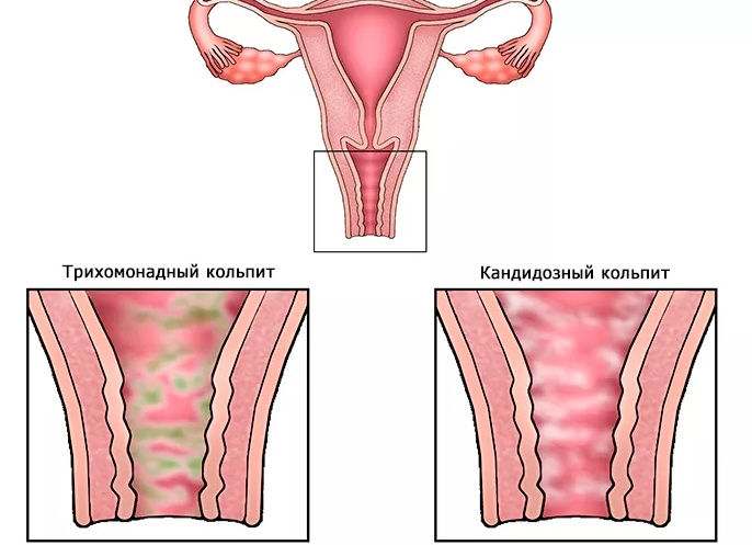 Кольпит — от симптомов до лечения