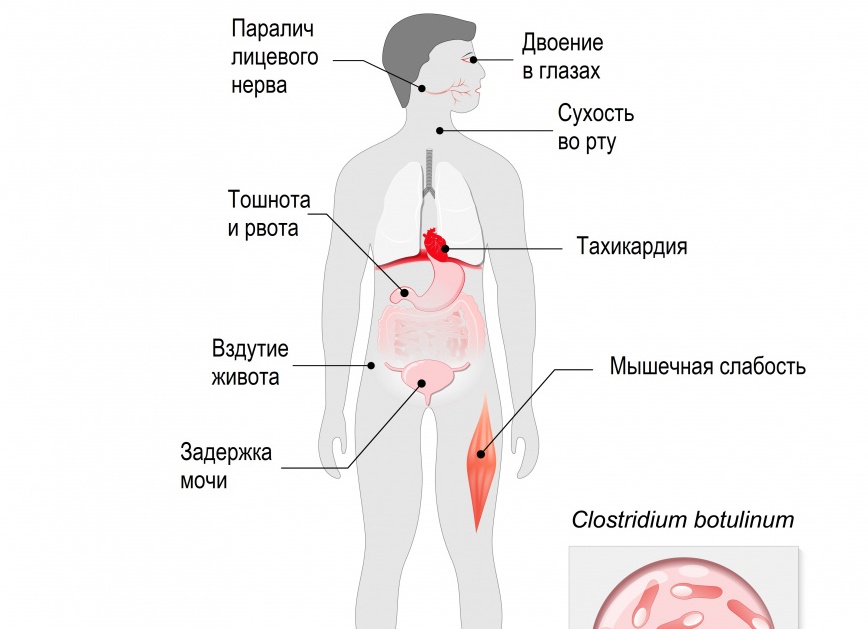 Ботулизм, что это за болезнь, какие симптомы и причины ее возникновения