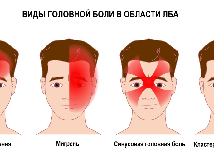 Головная боль в области лба