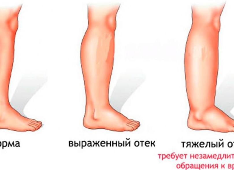 Отеки ног: причины и лечение