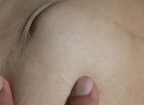Паховая грыжа: полный гид по симптомам, лечению и восстановлению без лишней паники