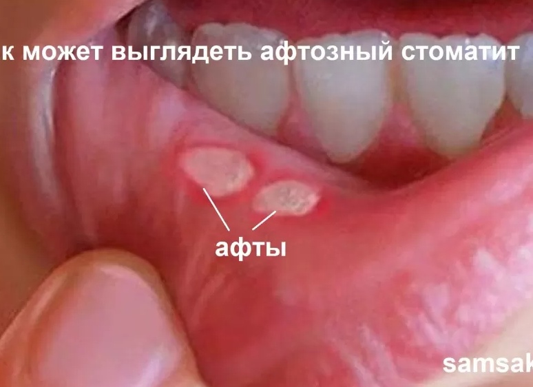 Стоматит: симптомы, причины, лечение
