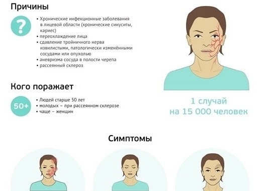 Тригеминальная невралгия: симптомы и лечение