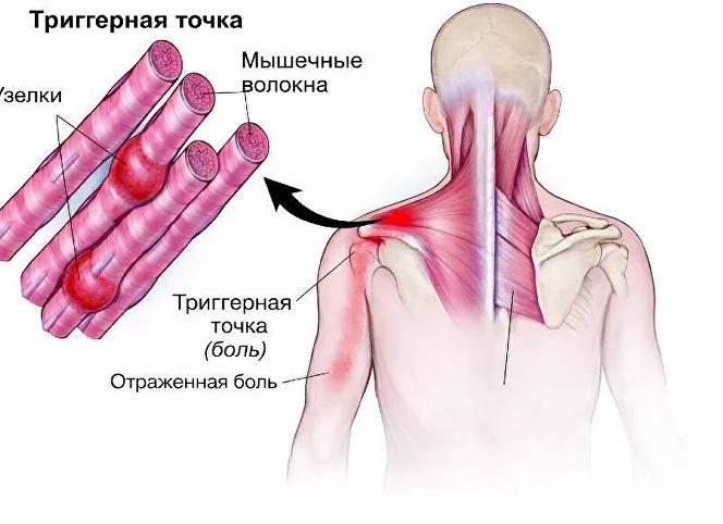 Миофасциальный синдром: причины, симптомы, лечение
