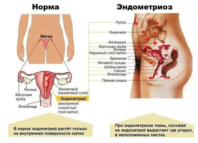 Эндометриоз: симптомы и лечение