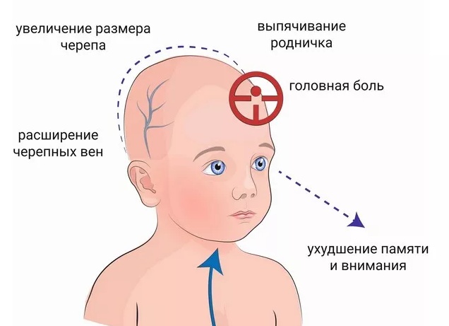 Симптомы внутричерепного давления и его лечение у взрослых