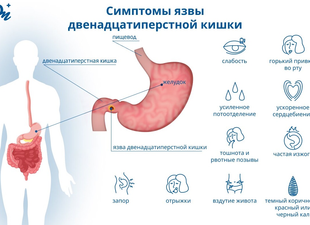 Язва двенадцатиперстной кишки: симптомы и лечение