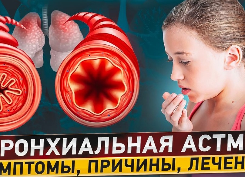 Бронхиальная астма: симптомы и лечение