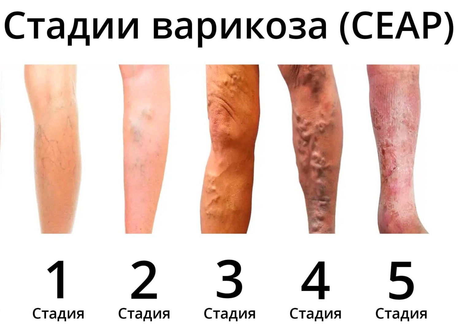 Варикозная болезнь: причины, симптомы, лечение и профилактика