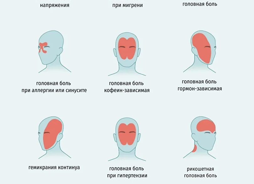 Причины сильной головной и глазной боли