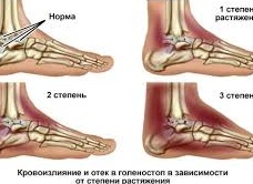 Растяжение связок — что это такое, причины, симптомы и лечение физиотерапией
