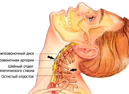 Шейный остеохондроз: причины, виды, симптомы и методы лечения