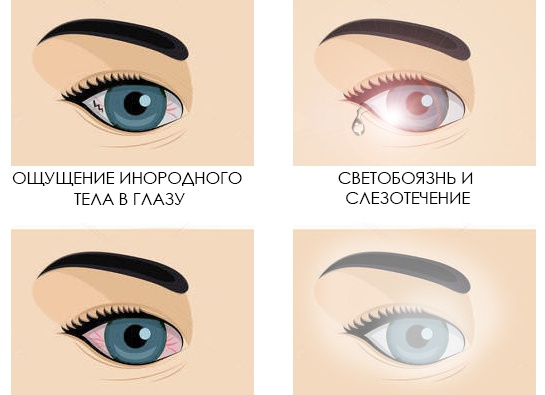 Синдром сухого глаза: симптомы, опасность для зрения и лечение