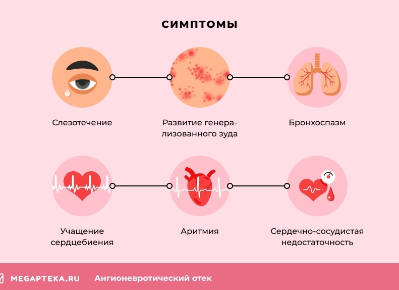 Ангионевротический отек: причины и лечение