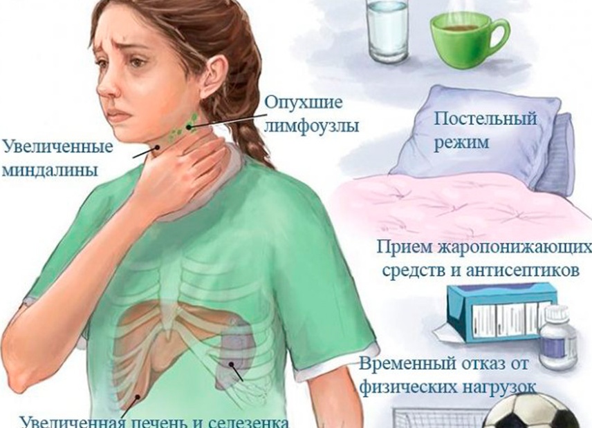 Инфекционный мононуклеоз: симптомы и лечение