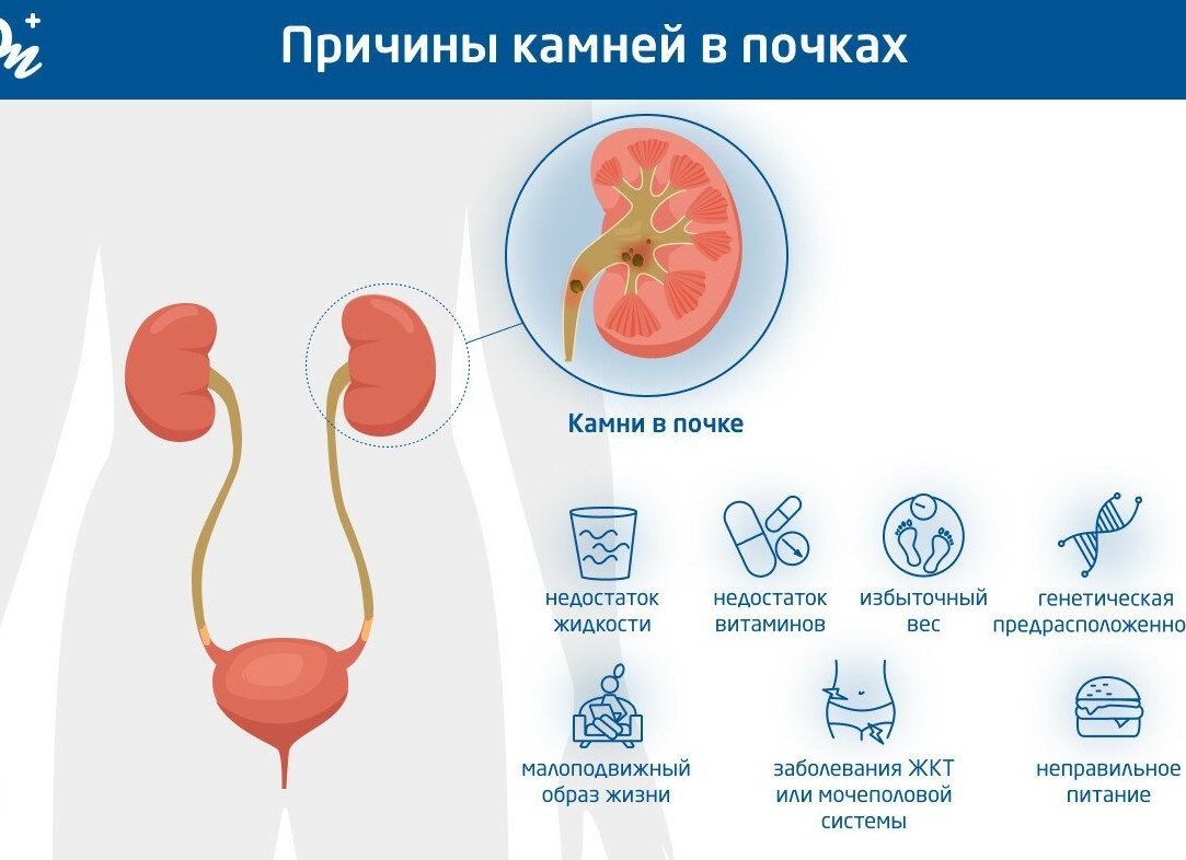 Камни в почках: причины, симптомы и лечение