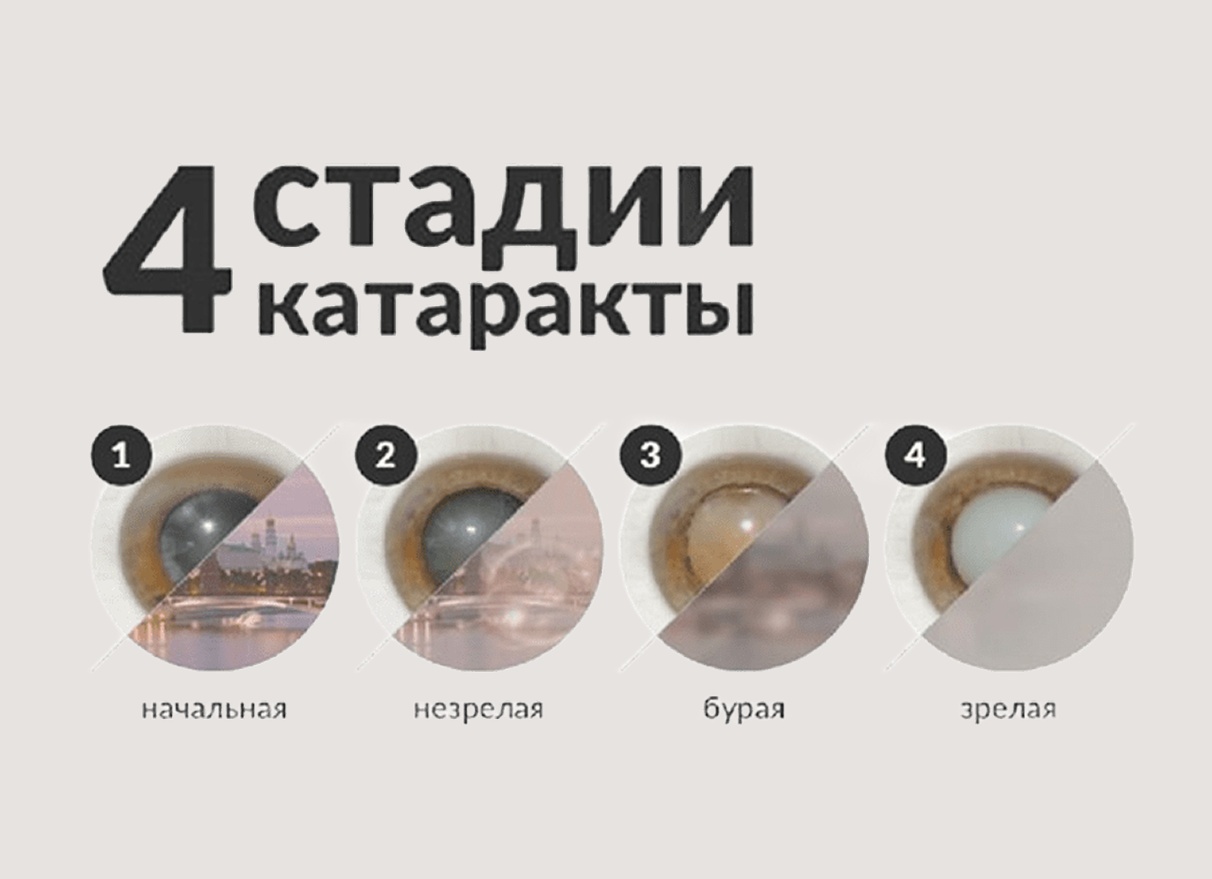 КАТАРАКТА — СИМПТОМЫ, ДИАГНОСТИКА И ЛЕЧЕНИЕ