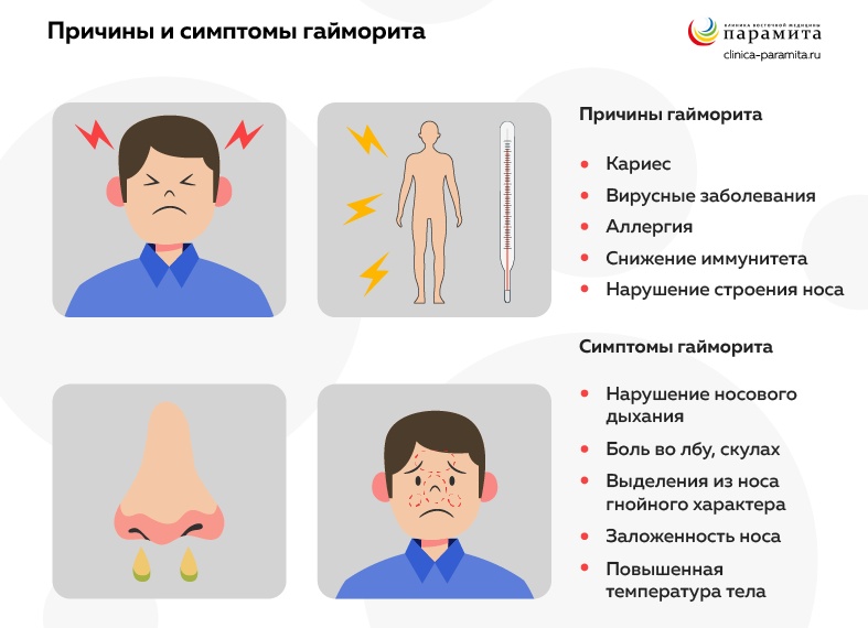 Хронический гайморит: симптомы и лечение