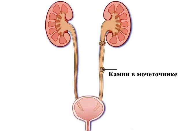 Камни в мочеиспускательном канале: причины, симптомы и лечение