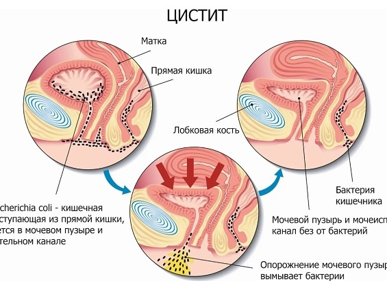 Болезни мочевого пузыря у женщин - симптомы и лечение
