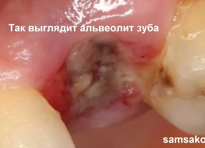 Альвеолит. Причины, лечение и как себя защитить от этого заболевания? Совет стоматолога