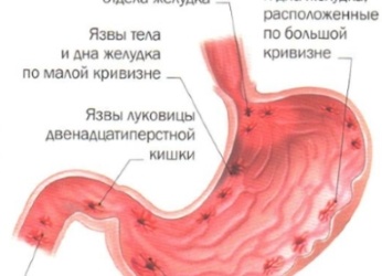 Язва желудка - симптомы и лечение.