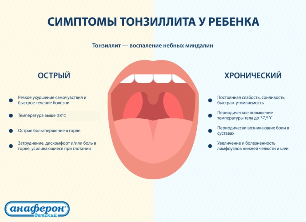 Ангина у ребенка – причины, симптомы и лечение