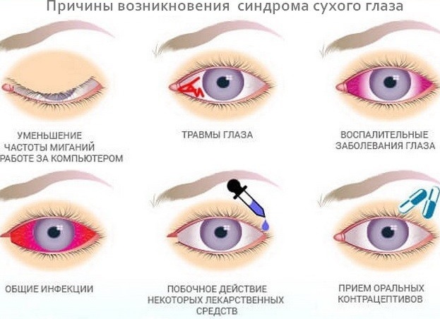 Синдром сухого глаза: симптомы, причины и возможные осложнения, лечение