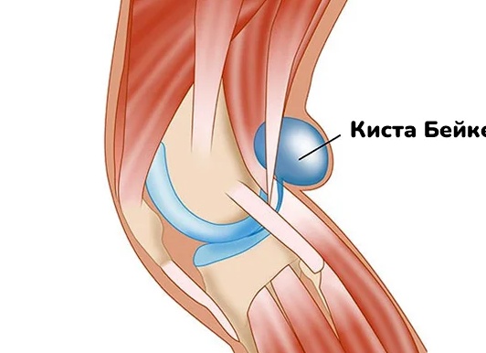 Киста Бейкера коленного сустава: причины, симптомы и диагностика.