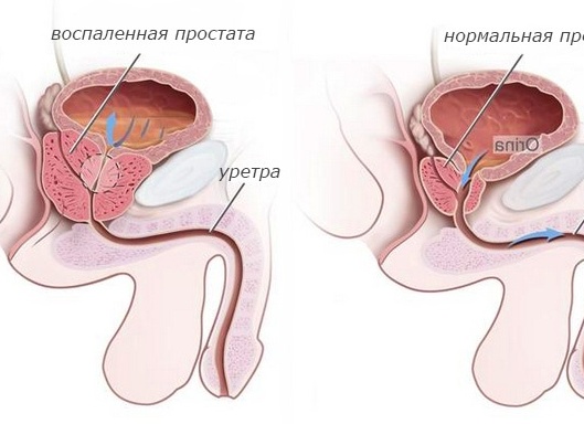 Простатит – симптомы и лечение
