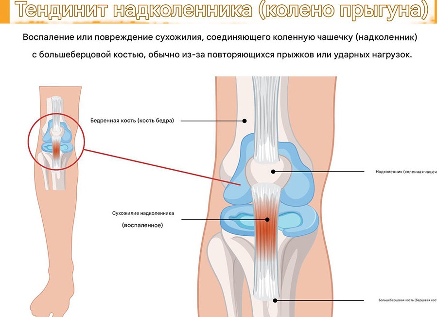 Тенденит коленного сустава: причины появления, симптомы, методы лечения