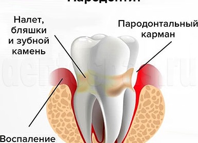 Пародонтит. Симптомы и причины.