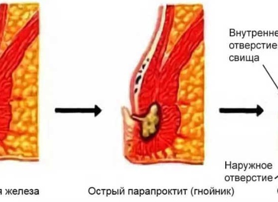 Подкожный парапроктит. Причины появления, симптомы и современные методы лечения!