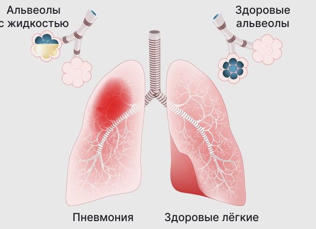 Как лечить пневмонию у взрослых в домашних условиях