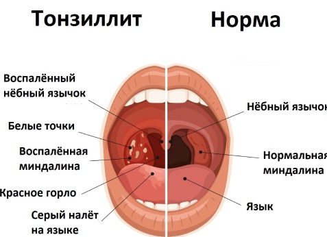 Ангина - тезисно о симптомах, причинах и лечении