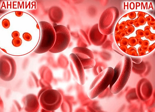 Анемия при хронических заболеваниях: симптомы, причины и лечение