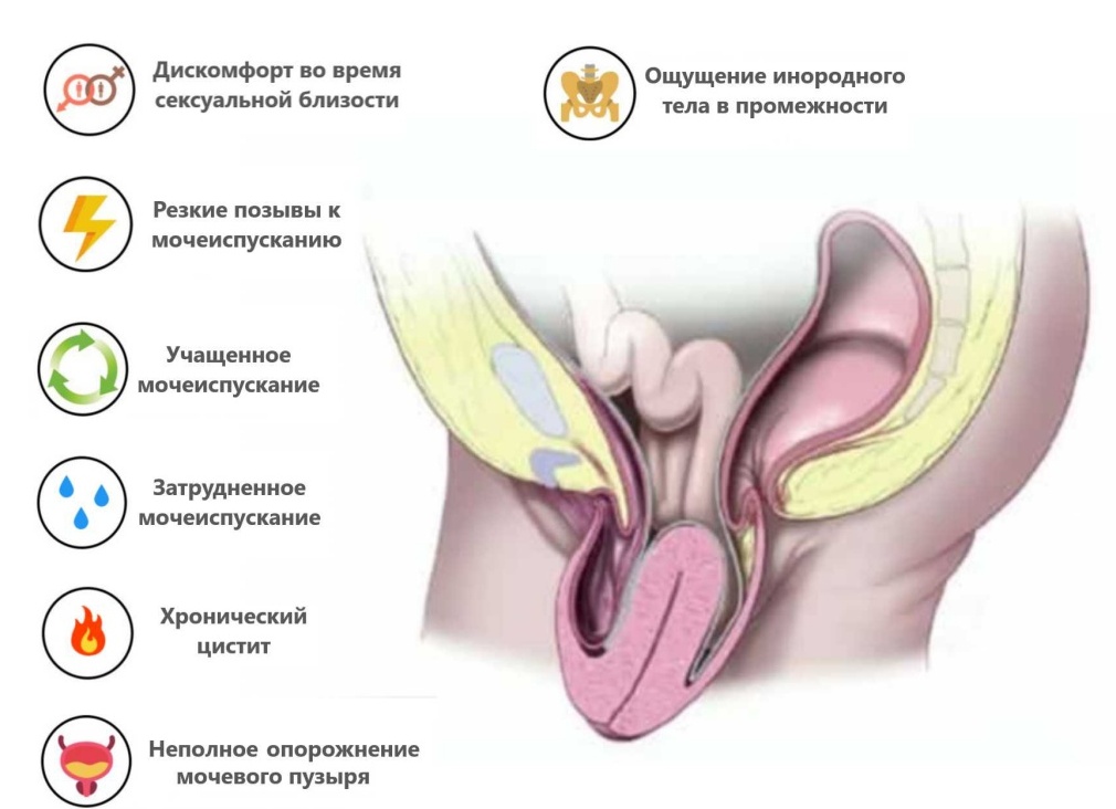 Опущение матки — от причин и симптомов до методов лечения