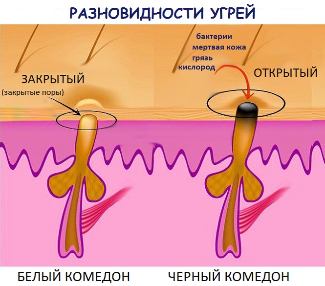 Процесс формирования и виды угрей на губах