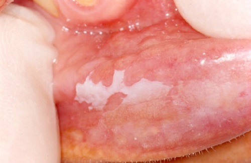 Лейкоплакия на нижней губе