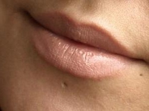 Маленький шрам на губе после пирсинга