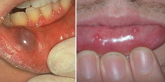 Слизистая киста на внутренней стороне губы