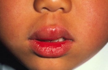 Отек губы при аллергии