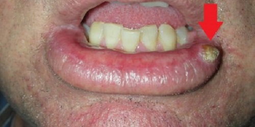 Рак нижней губы