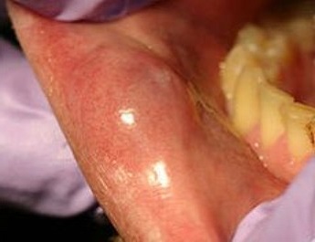 Пример шишки на внутренней стороне губы