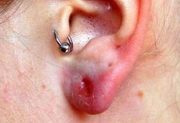 Инфекция мочки уха