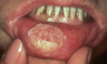 Белая рана при раке губы