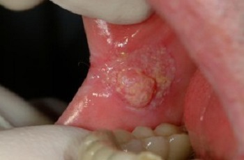 Шишка на внутренней стороне губы при раке