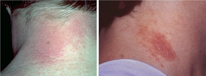 Контактный аллергический дерматит на шее