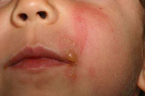 Аллергический контактный дерматит на лице после цветов